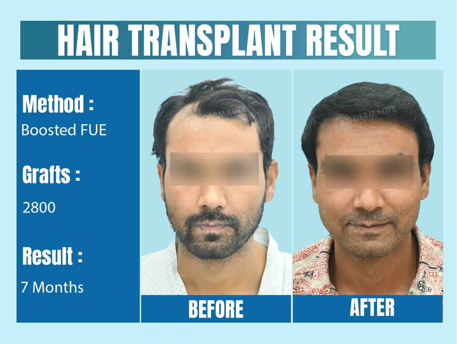 Best Hair Transplant Doctor In Delhi: Dr. Gaurav Garg